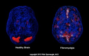 fibromyalgia-symptoms-fibromyalgia-brain-healthy-brain