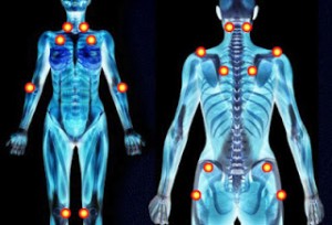 fibromyalgia-where-does-it-hurt-lupus-lyme-disease