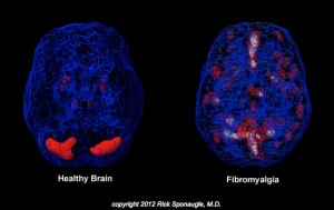 fibromyalgia-symptoms-fibromyalgia-brain-healthy-brain